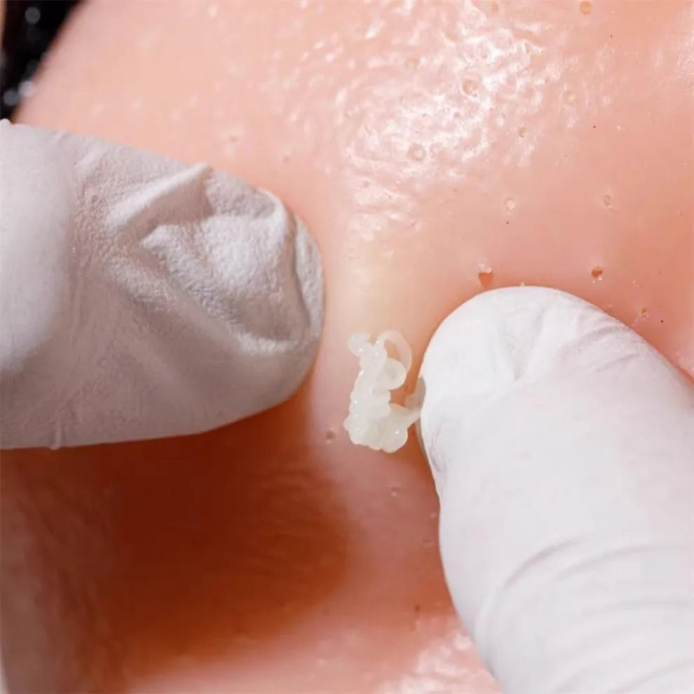 Refillable pimple popping head with gel included