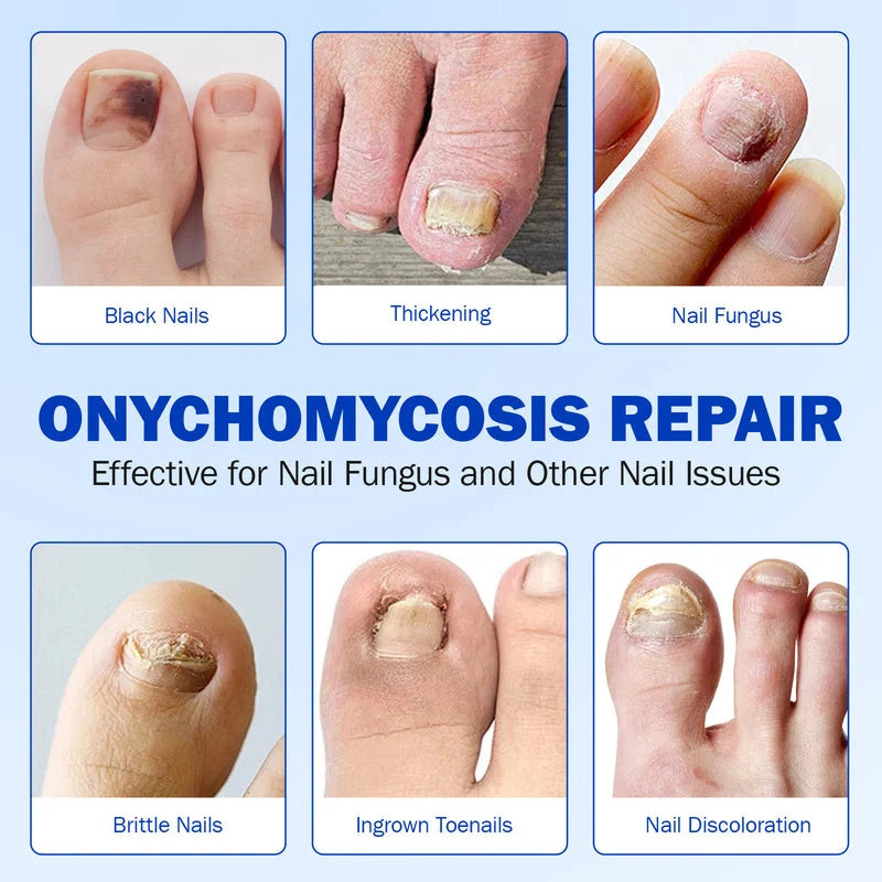 onychomycosis nail repair chart showing thickened nails discoloration brittle nails and ingrown toenails