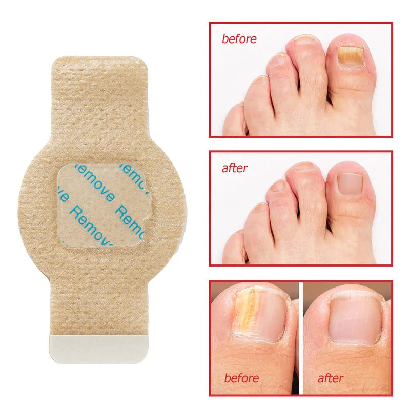 toenail fungus before and after results showing clearer and healthier nail appearance